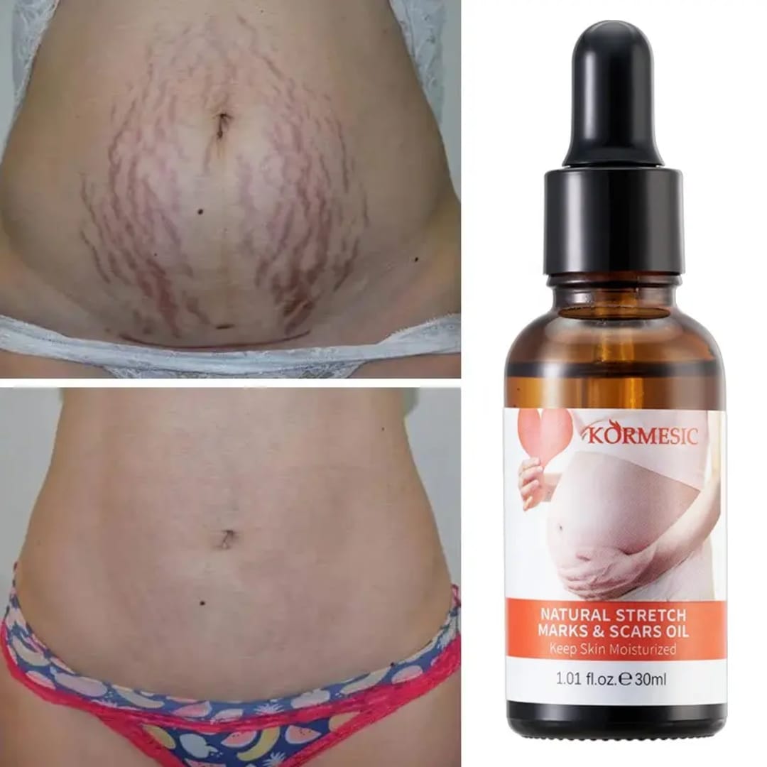 stretch mark repair oil